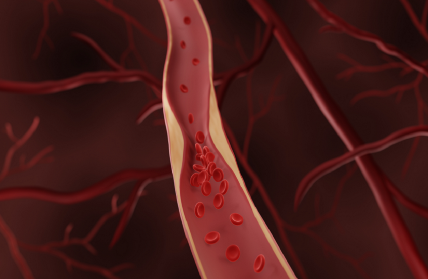 مضادات التخثر بجرعات علاجية عالية فعالة