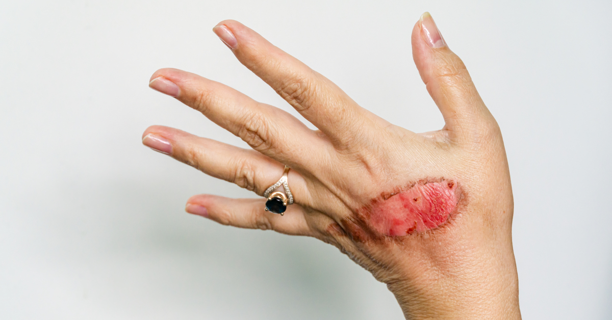 عدم سلامة الجلد في مواضع الحجامة